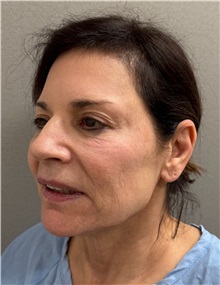 Neck Lift Before Photo by Keshav Magge, MD; Bethesda, MD - Case 51430