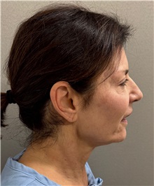 Neck Lift Before Photo by Keshav Magge, MD; Bethesda, MD - Case 51430