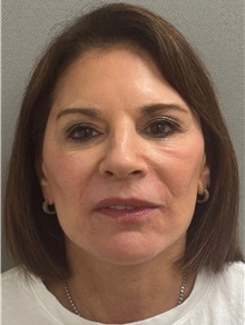 Neck Lift After Photo by Keshav Magge, MD; Bethesda, MD - Case 51430