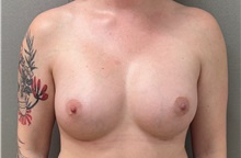 Breast Augmentation After Photo by Keshav Magge, MD; Bethesda, MD - Case 51601