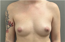 Breast Augmentation Before Photo by Keshav Magge, MD; Bethesda, MD - Case 51601