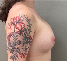Breast Augmentation After Photo by Keshav Magge, MD; Bethesda, MD - Case 51601