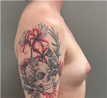 Breast Augmentation Before Photo by Keshav Magge, MD; Bethesda, MD - Case 51601