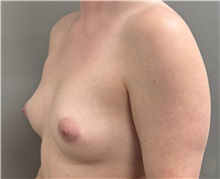 Breast Augmentation Before Photo by Keshav Magge, MD; Bethesda, MD - Case 51601