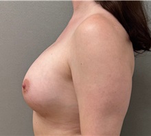 Breast Augmentation After Photo by Keshav Magge, MD; Bethesda, MD - Case 51601