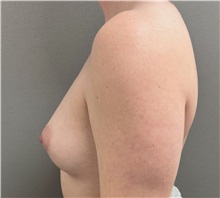 Breast Augmentation Before Photo by Keshav Magge, MD; Bethesda, MD - Case 51601