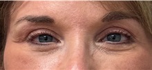 Eyelid Surgery After Photo by Keshav Magge, MD; Bethesda, MD - Case 51610