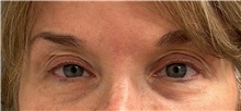 Eyelid Surgery Before Photo by Keshav Magge, MD; Bethesda, MD - Case 51610