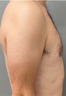 Male Breast Reduction After Photo by Keshav Magge, MD; Bethesda, MD - Case 49406