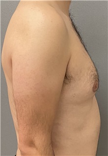 Male Breast Reduction Before Photo by Keshav Magge, MD; Bethesda, MD - Case 49406