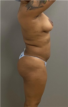 Buttock Lift with Augmentation Before Photo by Keshav Magge, MD; Bethesda, MD - Case 49408