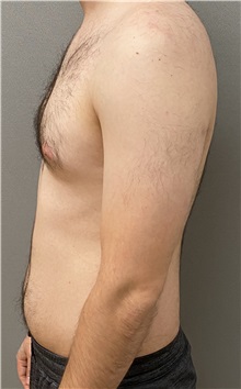 Male Breast Reduction Before Photo by Keshav Magge, MD; Bethesda, MD - Case 49405