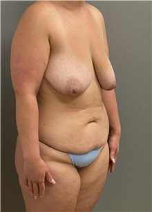 Tummy Tuck Before Photo by Keshav Magge, MD; Bethesda, MD - Case 49411