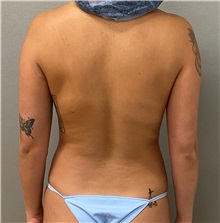 Liposuction Before Photo by Keshav Magge, MD; Bethesda, MD - Case 49417