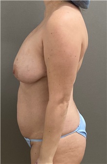 Tummy Tuck Before Photo by Keshav Magge, MD; Bethesda, MD - Case 49463