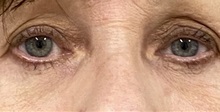 Eyelid Surgery After Photo by Keshav Magge, MD; Bethesda, MD - Case 49484