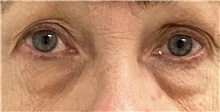 Eyelid Surgery Before Photo by Keshav Magge, MD; Bethesda, MD - Case 49484
