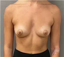 Breast Augmentation Before Photo by Keshav Magge, MD; Bethesda, MD - Case 49483