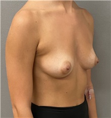 Breast Augmentation Before Photo by Keshav Magge, MD; Bethesda, MD - Case 49483