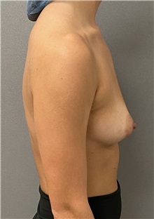 Breast Augmentation Before Photo by Keshav Magge, MD; Bethesda, MD - Case 49483