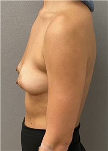 Breast Augmentation Before Photo by Keshav Magge, MD; Bethesda, MD - Case 49483