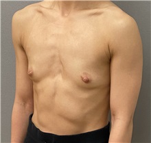 Breast Augmentation Before Photo by Keshav Magge, MD; Bethesda, MD - Case 49485