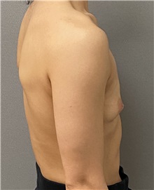 Breast Augmentation Before Photo by Keshav Magge, MD; Bethesda, MD - Case 49485