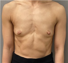 Breast Augmentation Before Photo by Keshav Magge, MD; Bethesda, MD - Case 49485