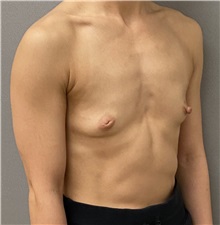 Breast Augmentation Before Photo by Keshav Magge, MD; Bethesda, MD - Case 49485