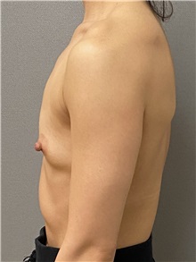 Breast Augmentation Before Photo by Keshav Magge, MD; Bethesda, MD - Case 49485