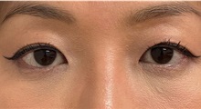 Eyelid Surgery After Photo by Keshav Magge, MD; Bethesda, MD - Case 49487