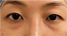 Eyelid Surgery Before Photo by Keshav Magge, MD; Bethesda, MD - Case 49487