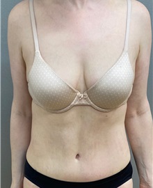Tummy Tuck After Photo by Keshav Magge, MD; Bethesda, MD - Case 49926