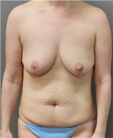 Tummy Tuck Before Photo by Keshav Magge, MD; Bethesda, MD - Case 49926