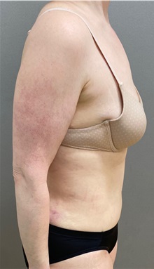Tummy Tuck After Photo by Keshav Magge, MD; Bethesda, MD - Case 49926