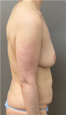 Tummy Tuck Before Photo by Keshav Magge, MD; Bethesda, MD - Case 49926