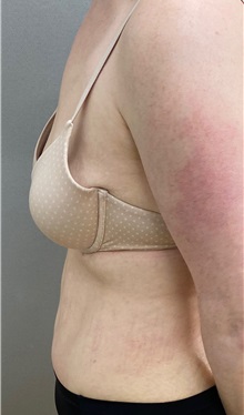 Tummy Tuck After Photo by Keshav Magge, MD; Bethesda, MD - Case 49926