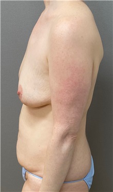 Tummy Tuck Before Photo by Keshav Magge, MD; Bethesda, MD - Case 49926