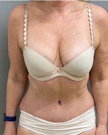 Tummy Tuck After Photo by Keshav Magge, MD; Bethesda, MD - Case 49927