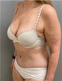 Tummy Tuck After Photo by Keshav Magge, MD; Bethesda, MD - Case 49927