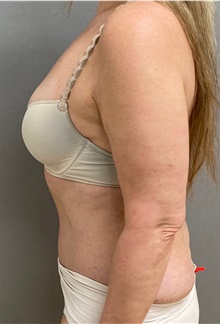Tummy Tuck After Photo by Keshav Magge, MD; Bethesda, MD - Case 49927