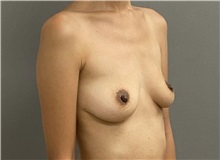 Breast Augmentation Before Photo by Keshav Magge, MD; Bethesda, MD - Case 49928