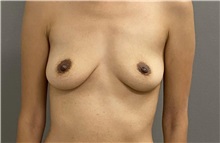 Breast Augmentation Before Photo by Keshav Magge, MD; Bethesda, MD - Case 49928