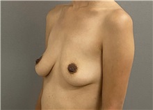 Breast Augmentation Before Photo by Keshav Magge, MD; Bethesda, MD - Case 49928