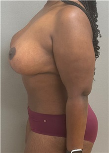 Tummy Tuck After Photo by Keshav Magge, MD; Bethesda, MD - Case 49493