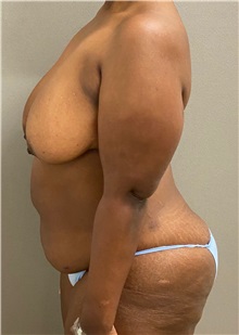 Tummy Tuck Before Photo by Keshav Magge, MD; Bethesda, MD - Case 49493