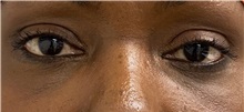 Eyelid Surgery After Photo by Keshav Magge, MD; Bethesda, MD - Case 49497