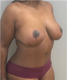 Breast Lift After Photo by Keshav Magge, MD; Bethesda, MD - Case 49494