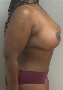 Breast Lift After Photo by Keshav Magge, MD; Bethesda, MD - Case 49494