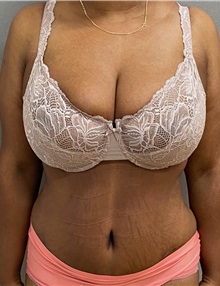 Tummy Tuck After Photo by Keshav Magge, MD; Bethesda, MD - Case 49562
